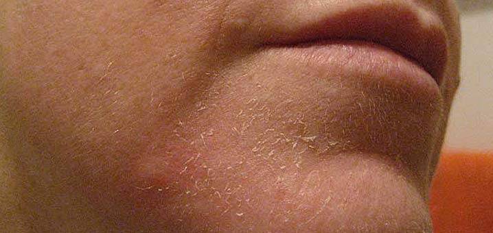 Red Flaky Rash around Nose... Help! - Dermatology - MedHelp