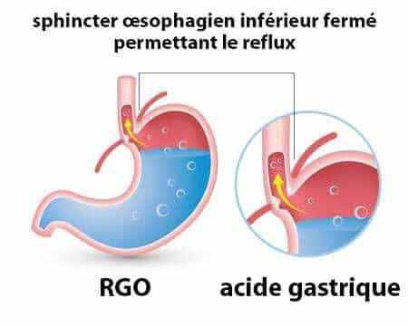 reflux gastro œsophagien, schéma explicatif