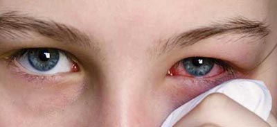 congiuntivite: occhio rosso infiammato