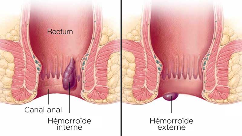 infographie hemorroide interne externe