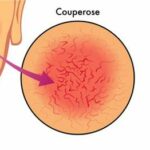 Acné Rosacée : Les Remèdes de Grand-Mère contre la Couperose