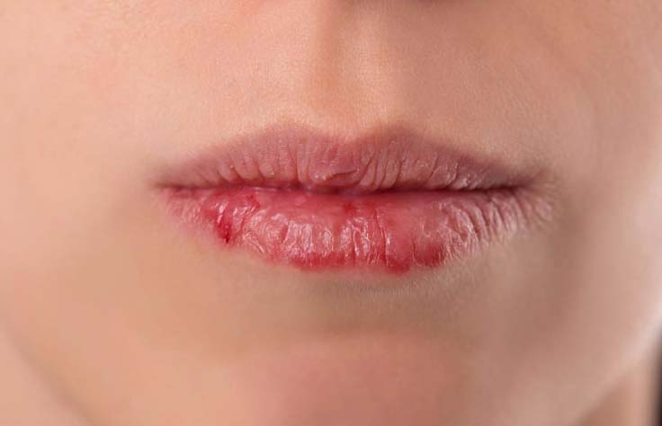 natuurlijke verzorging voor gesprongen lippen