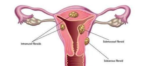 Soigner les tumeurs de l'utérus