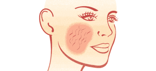 Soigner l'acné rosacée
