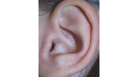 soigner naturellement un eczéma d'oreille