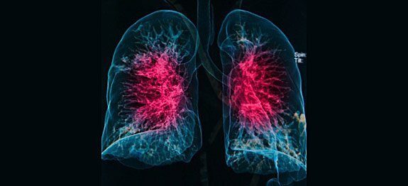 Remèdes pour inflammation pulmonaire et bronchique