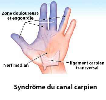 syndrome du canal carpien : schéma explicatif