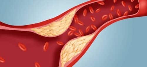 3 remèdes naturels efficaces contre le mauvais cholestérol