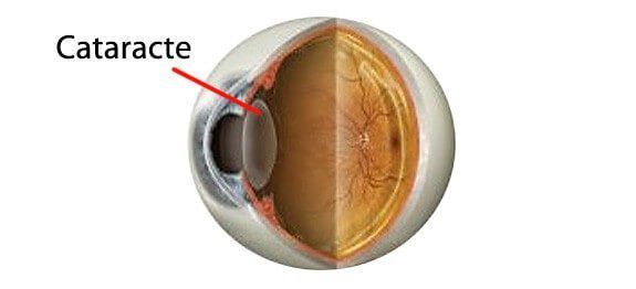 Soigner naturellement la cataracte