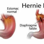 Remèdes Maison Contre l’Hernie Hiatale