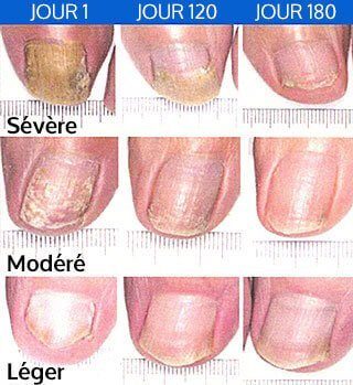 soigner mycose des ongles naturellement