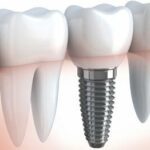Implants dentaires : Comment réduire votre budget ?