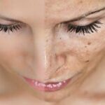 Comment atténuer naturellement  l'hyperpigmentation de la peau