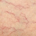 Varicosités Jambes et Visage : Soins Naturels