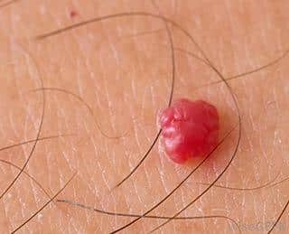 angiome cerise - hémangiome capillaire