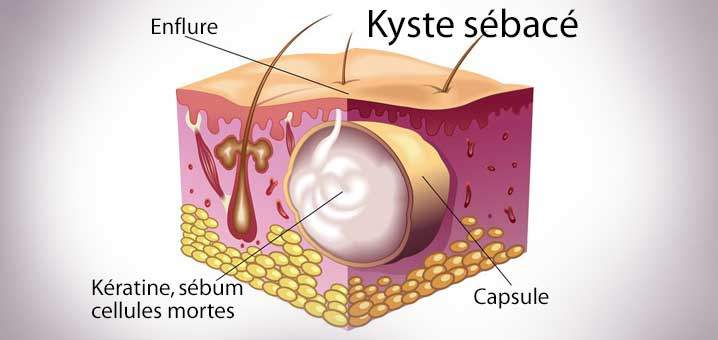 comment enlever un kyste sébacé naturellement