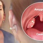 Caséum sur les amygdales : Les remèdes naturels efficaces pour s'en débarrasser