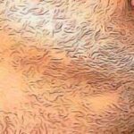 Pelade de la barbe : Quels remèdes naturels
