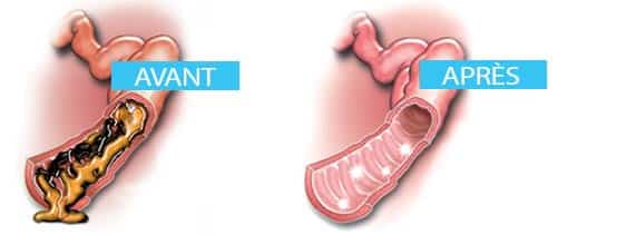 colon obstrué - colon sain