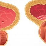 Hypertrophie de la prostate : Remèdes naturels