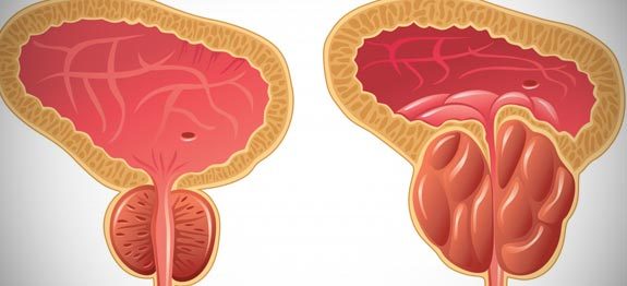 Hypertrophie de la Prostate : Remèdes Naturels | Remèdes de Grand-Mere