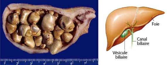 vésicule biliaire et calculs