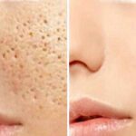 20 remèdes maison pour resserrer les pores dilatés du visage définitivement