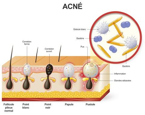 process of appearance of acne