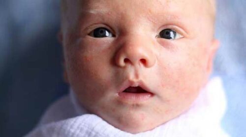comment soigner naturellement l'acné de bébé