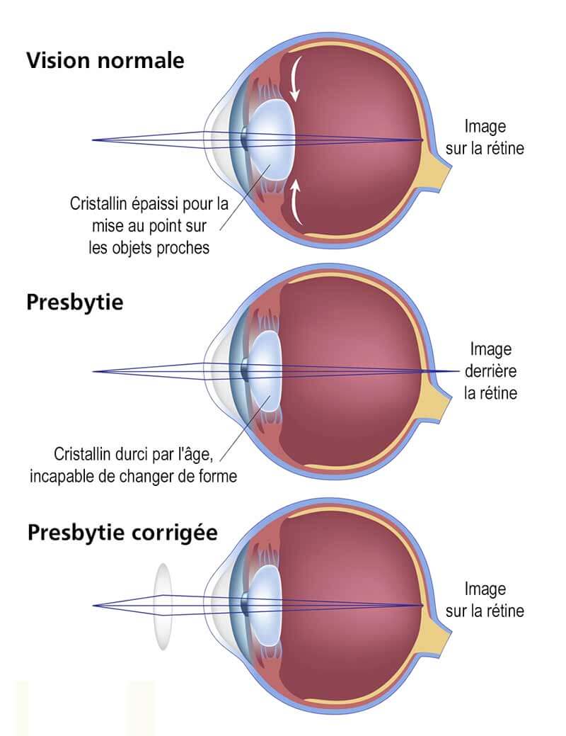 presbytie expliquée