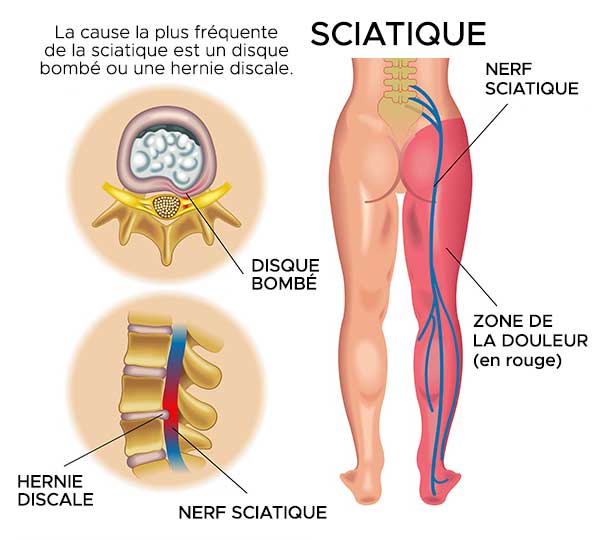 sintomi del dolore al nervo sciatico