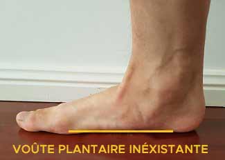 pieds plat voute plantaire inexistante