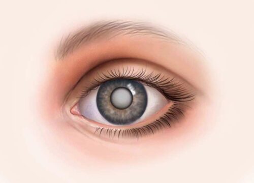 conseils pour prévenir la cataracte