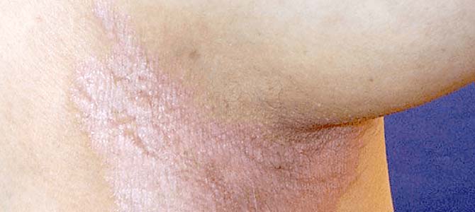 Le psoriasis inversé et l'intertrigo affectent tous deux les zones où la peau se plisse.