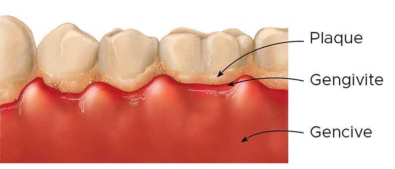 hoe ontstaat tandsteen in de tanden?