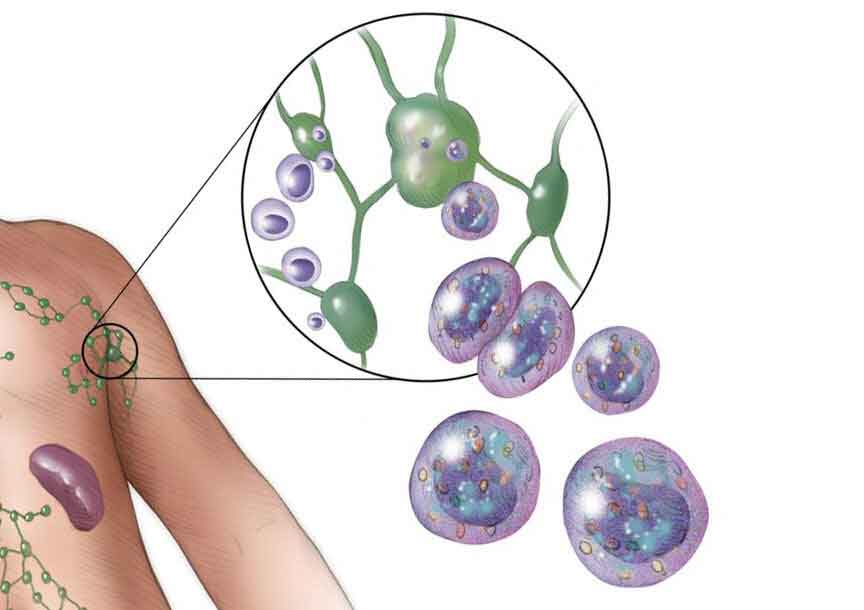 ganglions lymphatiques