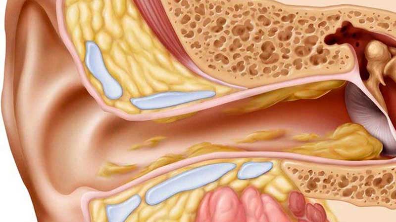 cérumen dans oreille