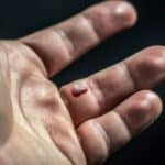 Faut-il percer une bulle de sang formée sur un doigt ?