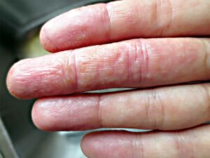 dyshidrose : ce qu'il ne faut pas faire pour éviter aggravation