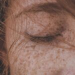 Réduire les taches de rousseur naturellement : Découvrez des astuces et traitements efficaces
