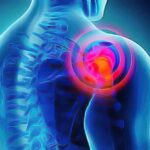 Capsulite de l'épaule : Découvrez 5 solutions naturelles efficaces pour soulager la douleur