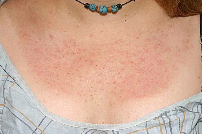 préparer sa peau pour éviter une lucite estivale