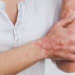 Psoriasis : solutions naturelles et astuces pour apaiser la peau