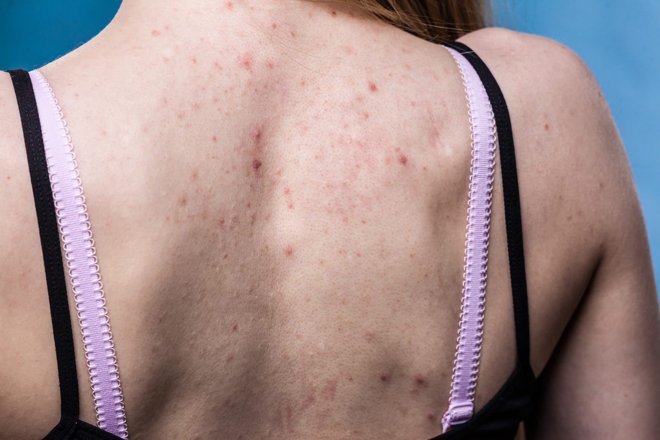 Quand la nature s'en mêle : les alliés incontournables pour une peau nette
